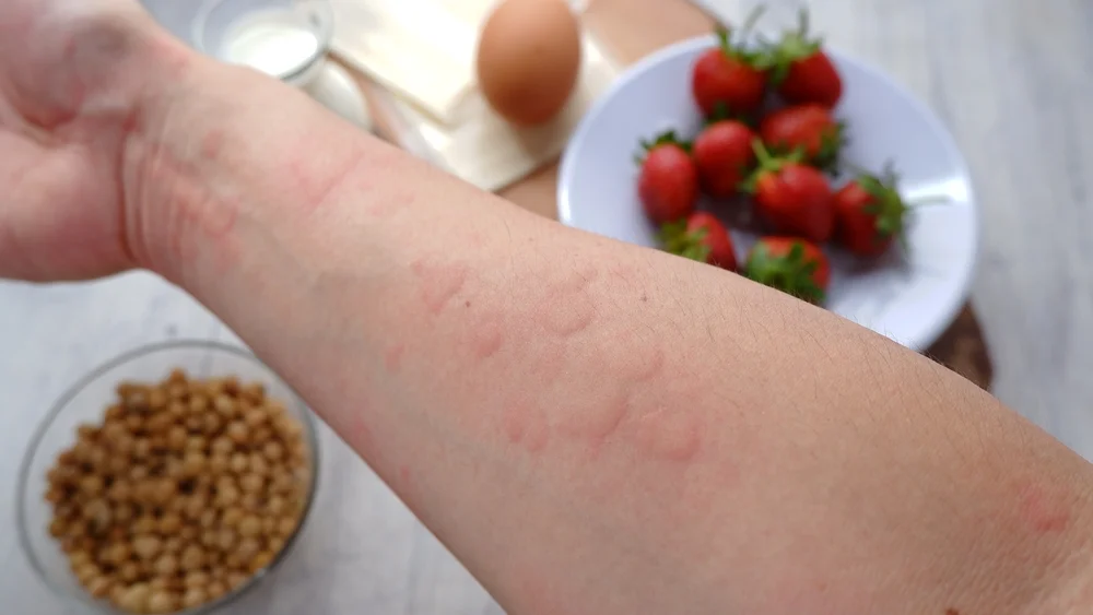 How To Know If You Have a Food Allergy Food Allergy