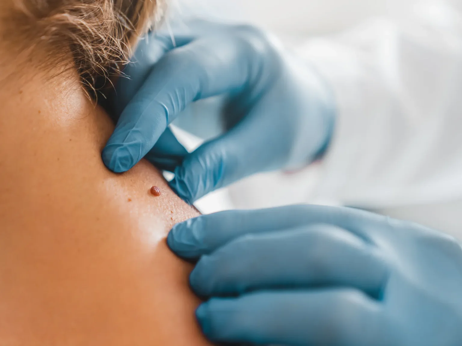 Treat Skin Tags