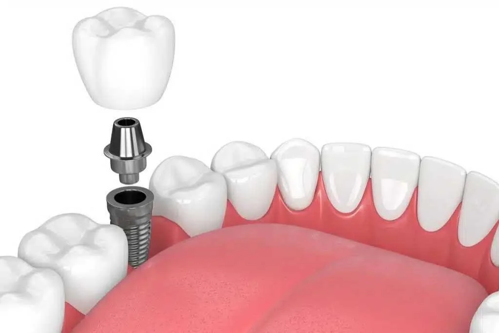 Exploring the Different Types of Dental Implants Available Dental Implants