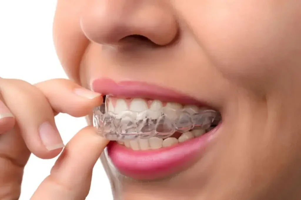 Five Advantages of Invisalign Treatment Invisalign Treatment