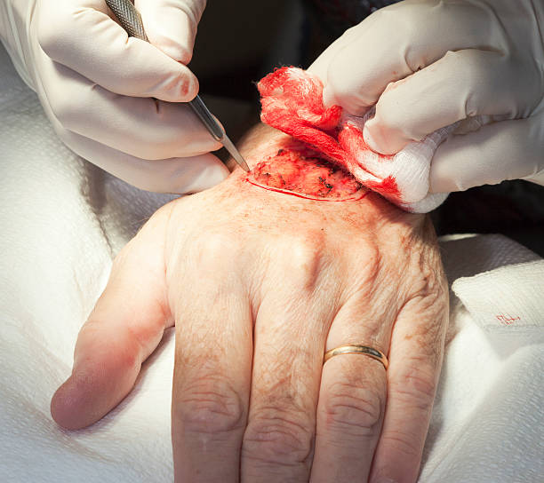 How Does Mohs Surgery Work Mohs Surgery