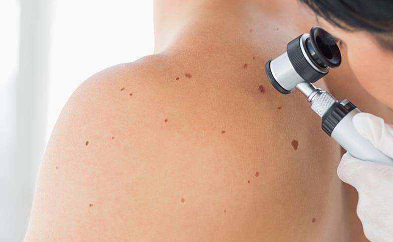 The Benefits of Regular Skin Cancer Screenings Skin Cancer Screenings