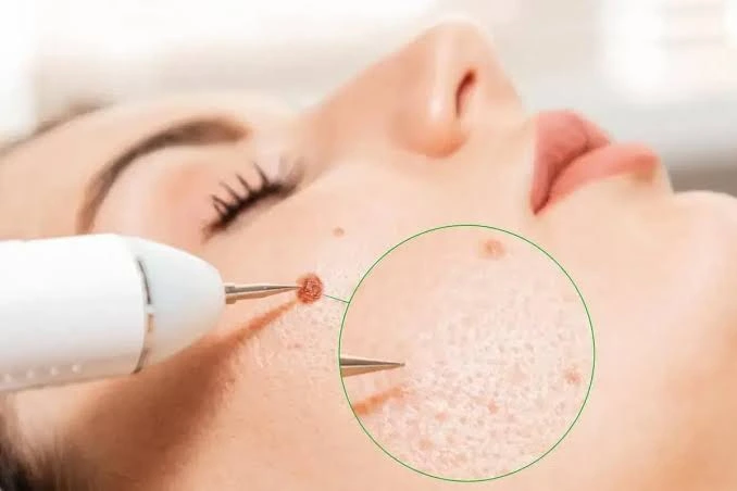 Post-operative Care After Skin Cancer Surgery Skin Cancer Surgery