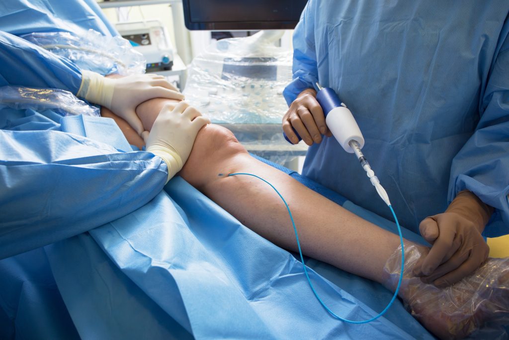 Prevention and Treatment Strategies for Varicose Veins Varicose Veins