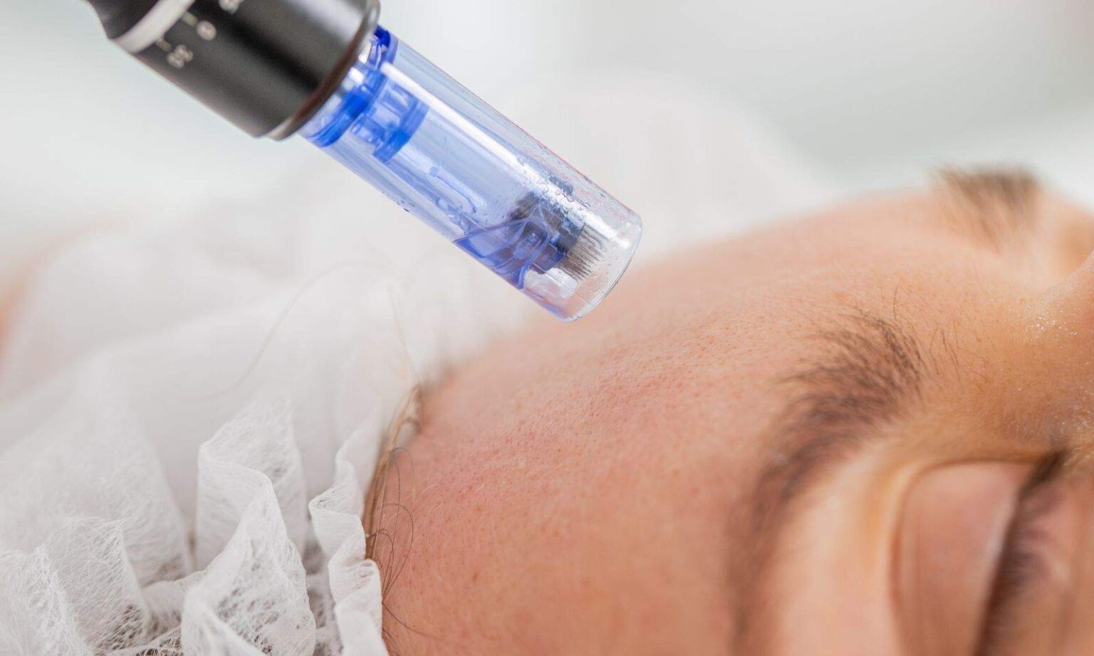 Knowing if Microneedling Is Right for You Microneedling