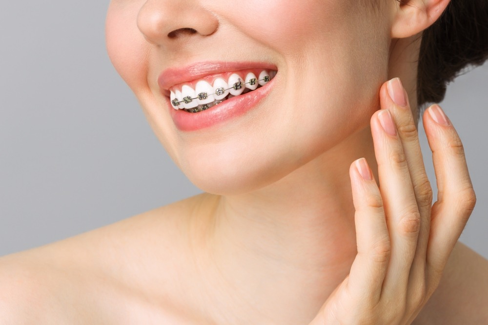 Why Teeth Straightening Is More Than Just Aesthetic Teeth Straightening