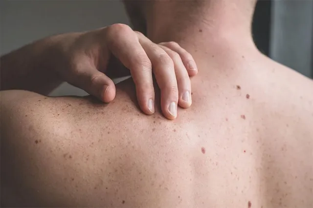 Common Skin Infections and Their Treatment Options Common Skin Infections