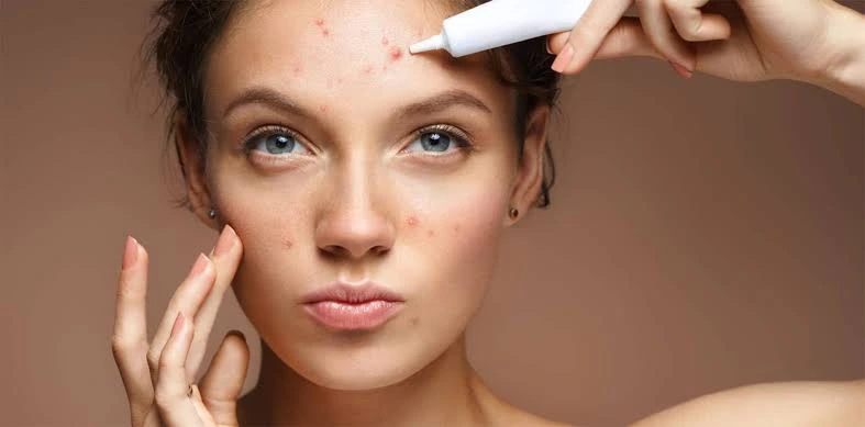 What Works and What Doesn’t When Finding Remedies for Acne Remedies for Acne